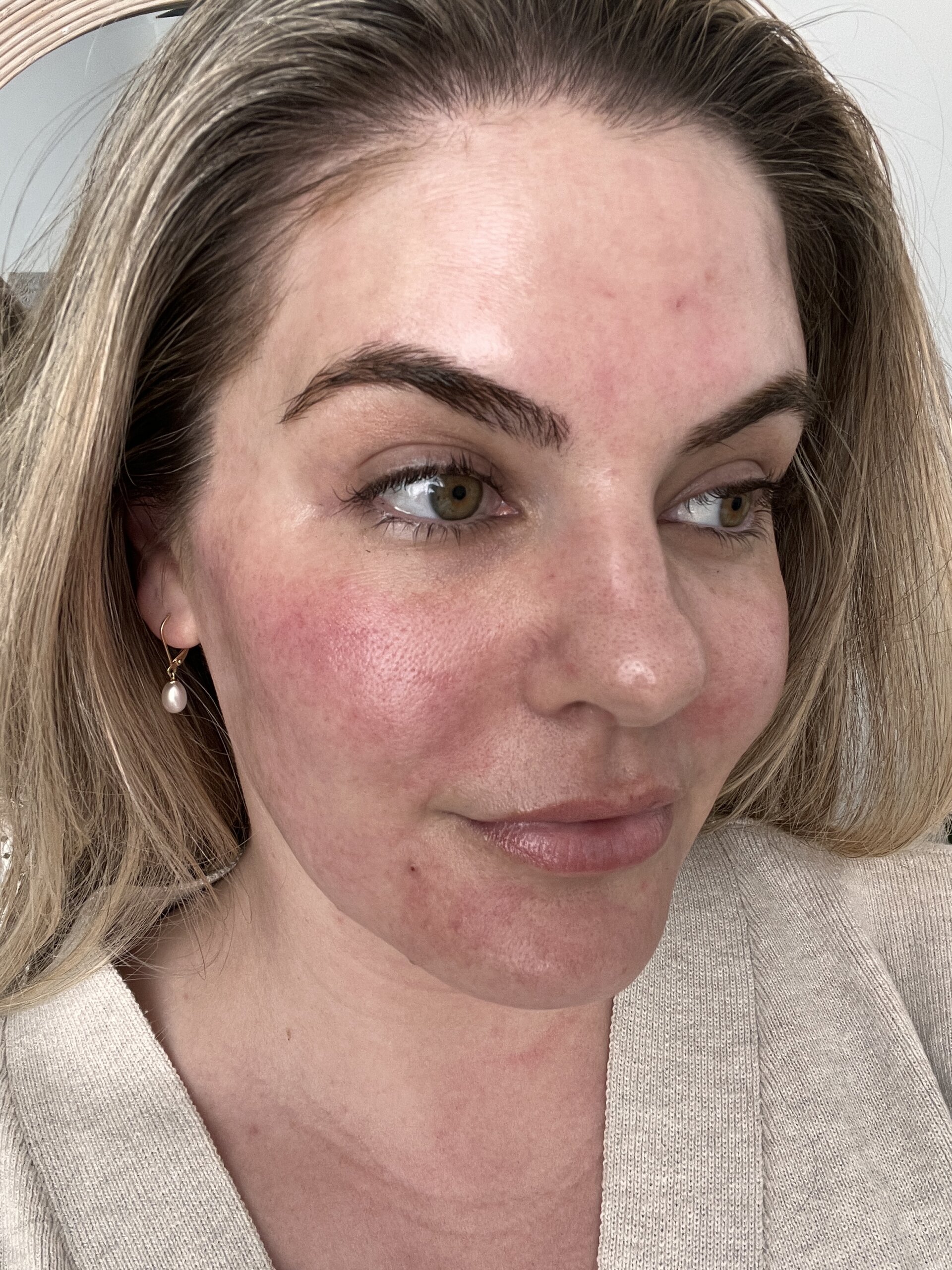 Honest review of the BioRepeel Peel Skin Treatment - Lauren Erro